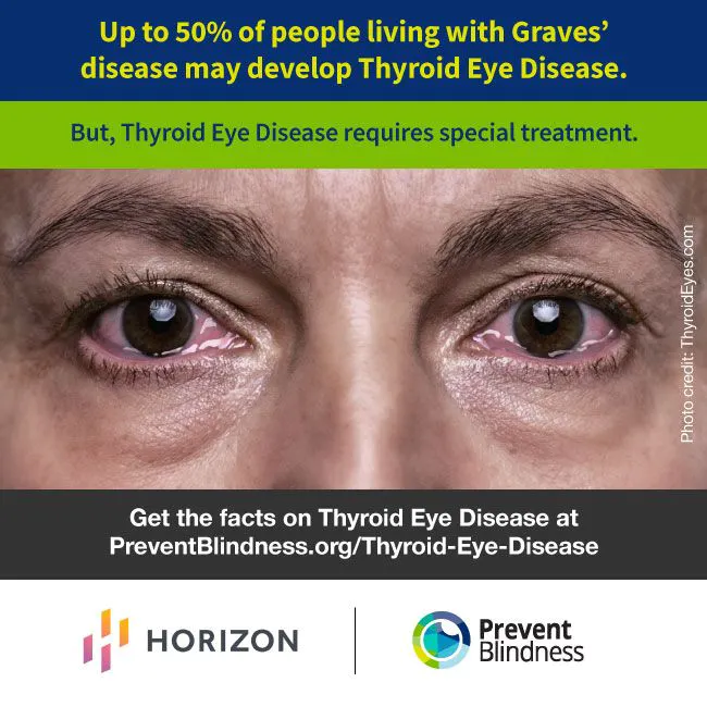 Thyroid Eye Disease Research And Resources Ted Education 3651